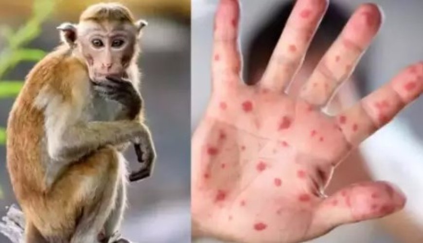 देश में monkeypox की एंट्री, विदेश से लौटा युवक मिला प्रभावित